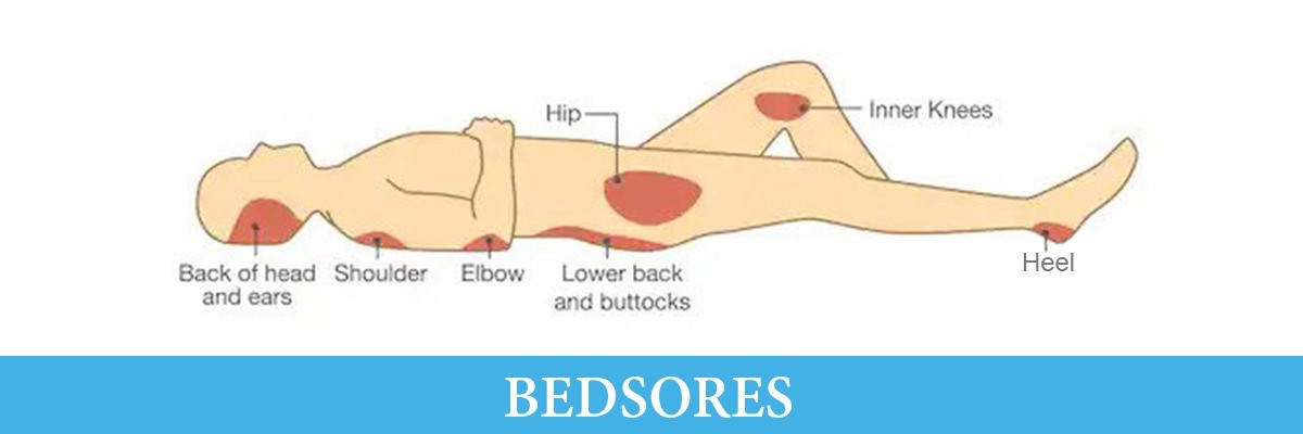 preventing bed sores mattress